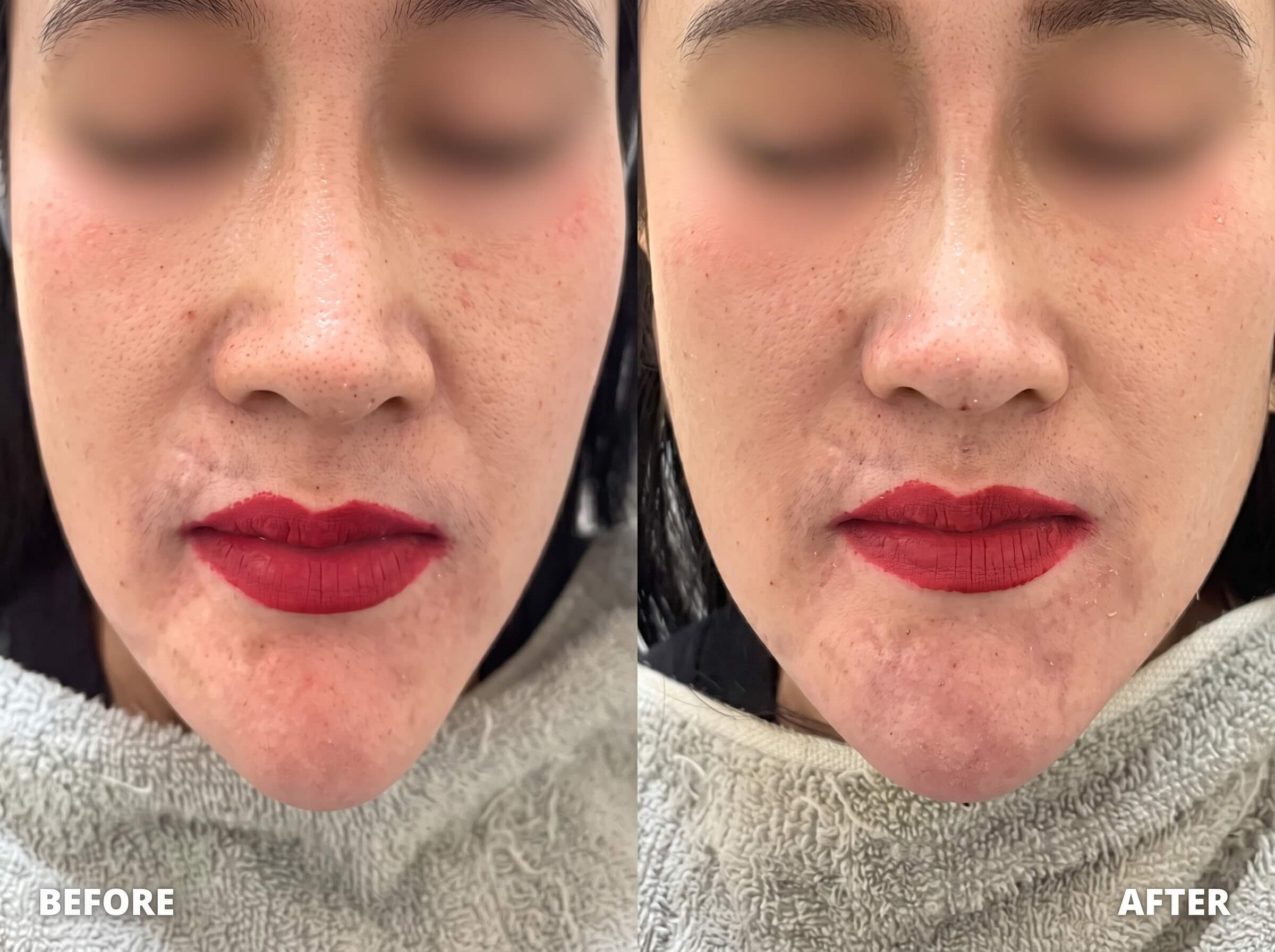 Prosedur Filler Dagu dan Botox Rahang Mahayu Aesthetic Clinic