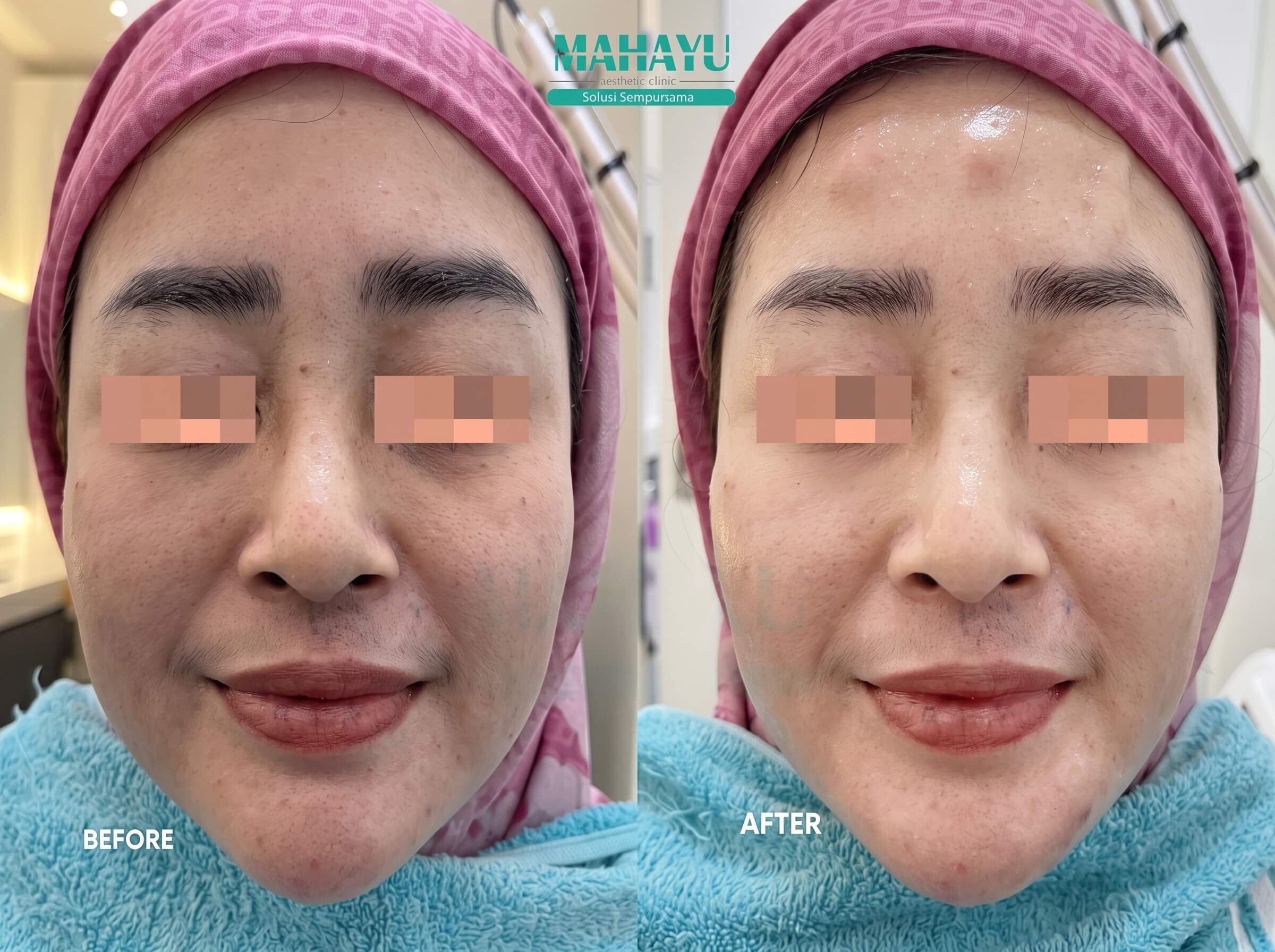 Prosedur Mahayu Photofacial Glass Skin Laser